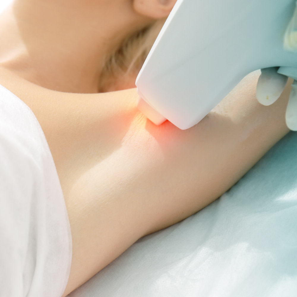 Almea Epilazione Laser 